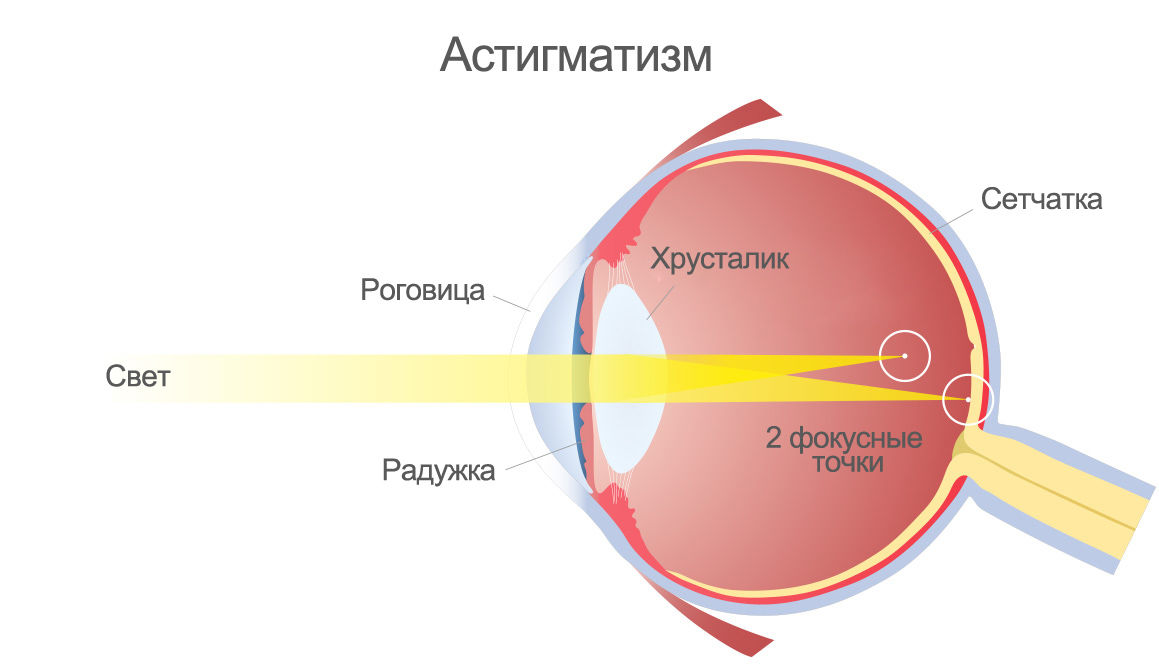 Наличие двух фокусных точек — последствие искривления роговицы © Материал предоставлен клиникой «Три-З» Наличие двух фокусных точек — последствие искривления роговицы © Материал предоставлен клиникой «Три-З»