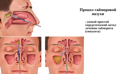 Прокол гайморовой пазухи Прокол гайморовой пазухи