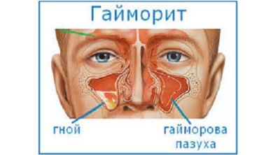 почему после высокой температуры болит спина
