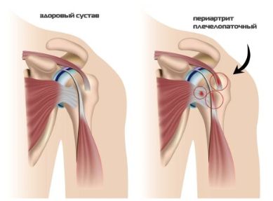 Болит спина в области лопаток болит левая рука