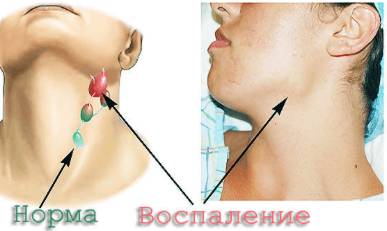 почему после высокой температуры болит спина