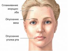 Асимметрия лица при защемлении