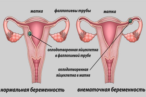 Боль внизу живота слева у женщин в паху. Причины и что делать