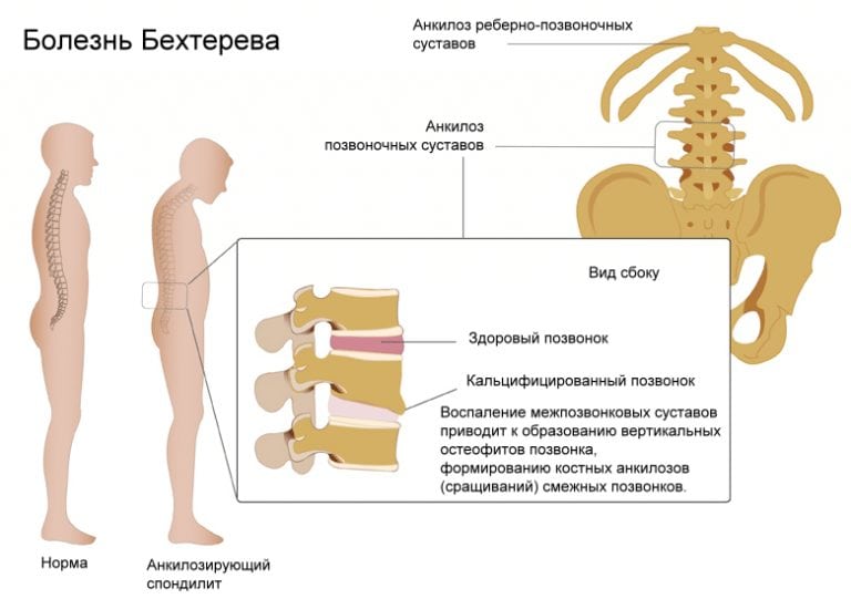 Болит спина справа как лечить