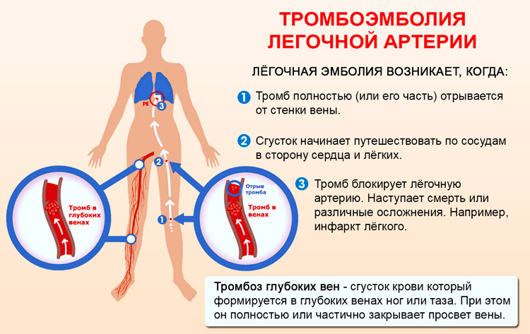 Тромбоэмболия легочной артерии Закупоркой ствола или ветвей легочной артерии