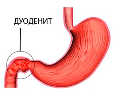 Дуоденит