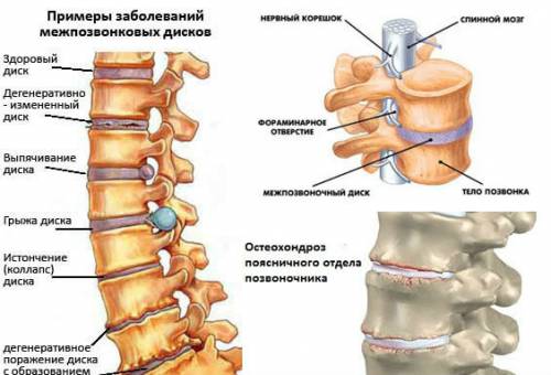 Дегенеративные поражения позвоночника Дегенеративные поражения позвоночника