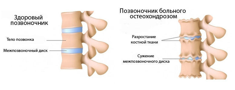 Остеохондроз позвоночника Остеохондроз позвоночника