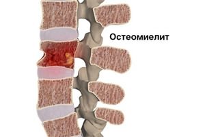 почему после высокой температуры болит спина