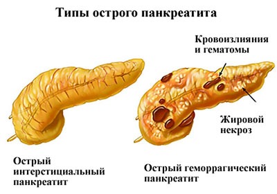 Два типа острого панкреатита