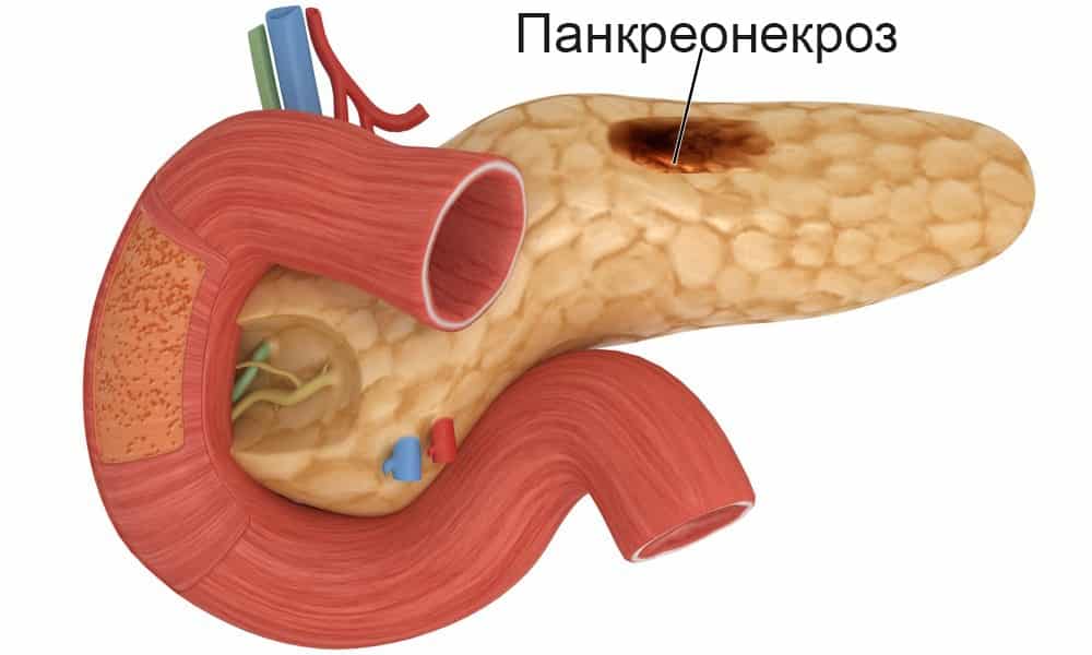Осложнением панкреатита может стать панкреонекроз - полное разрушение поджелудочной железы, а также рак