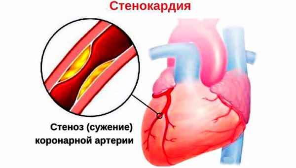 Боль в грудной клетке при кашле с левой, правой стороны, посередине. Что это, причины, лечение