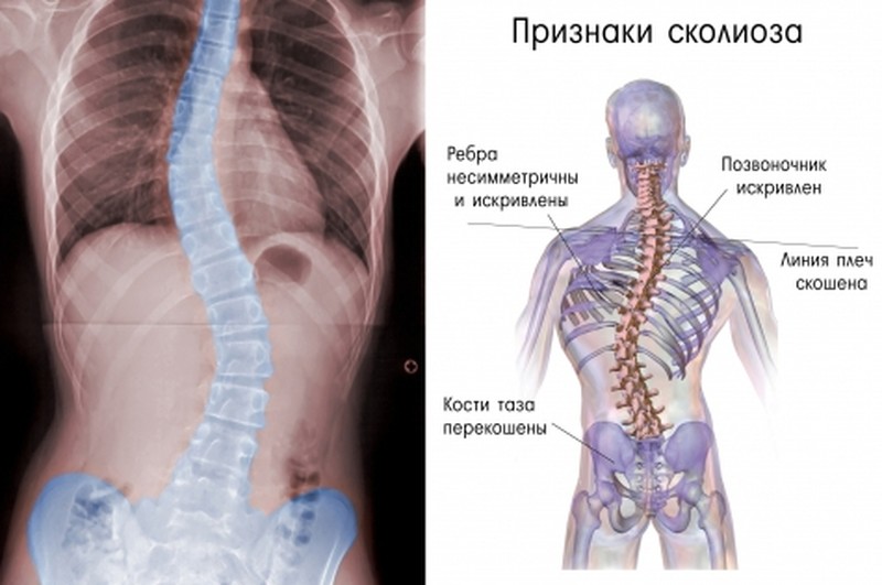 Признаки сколиоза позвоночника Признаки сколиоза позвоночника