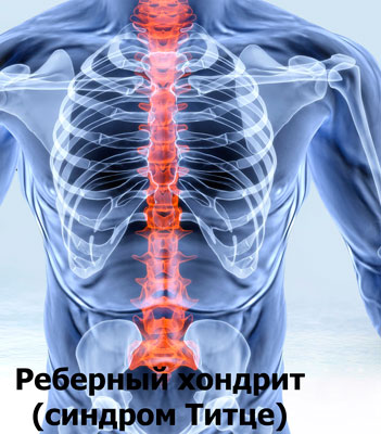 Синдром Титце