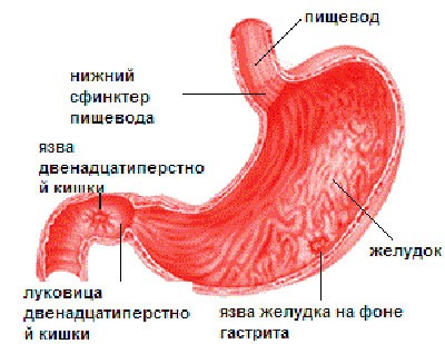 Язва желудка и 12-ти перстной кишки