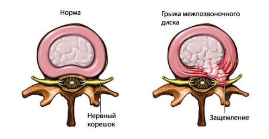 Защемление нерва при грыже