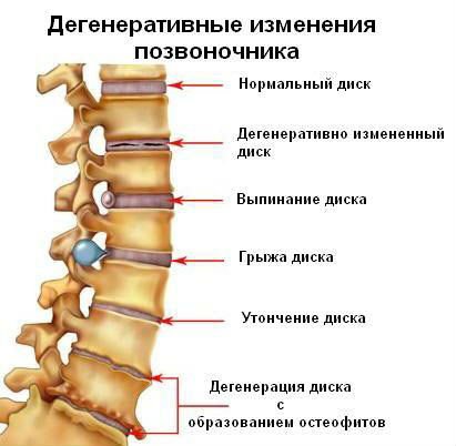 Патологии позвоночника